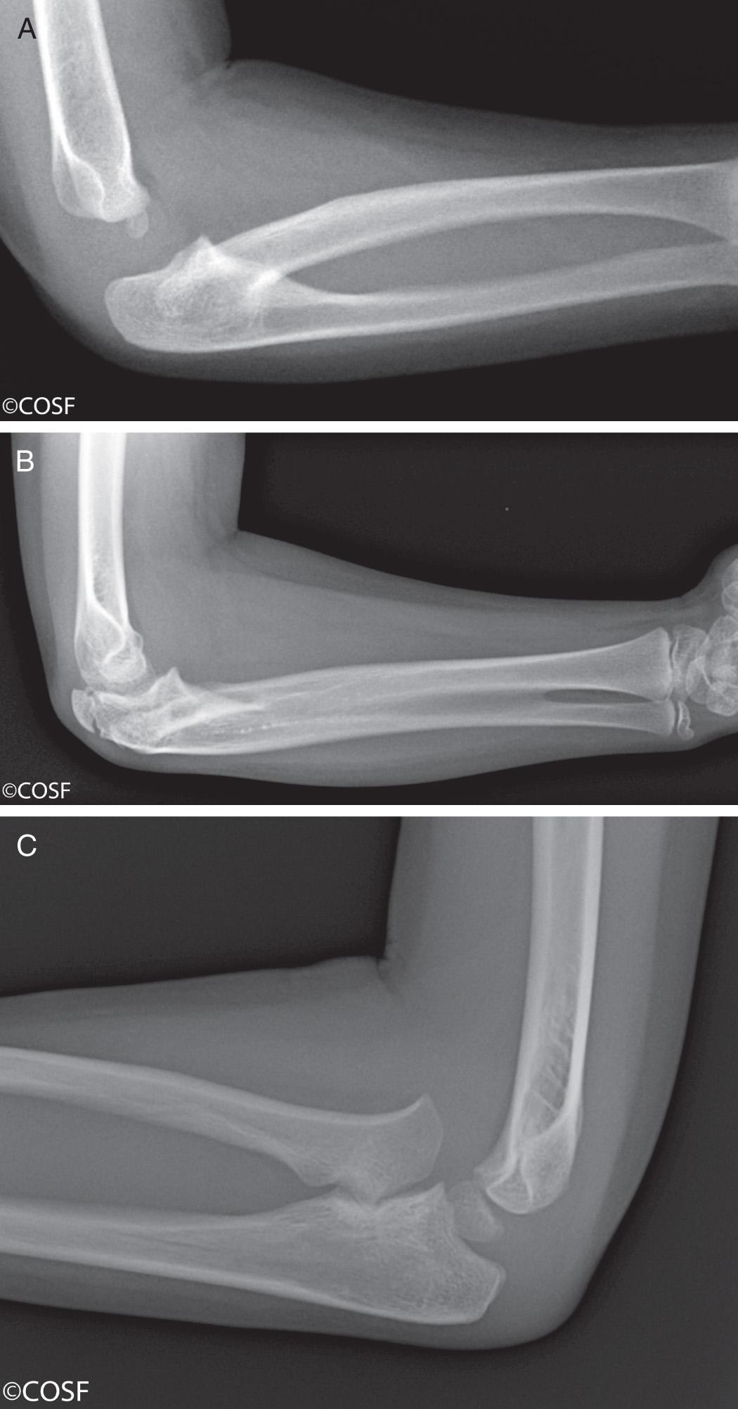 FIG 26.7, Radioulnar synostosis. (A) Typical proximal radioulnar synostosis with posterior dislocation of the radial head. (B) Long-segment synostosis. (C) Incomplete/partial synostosis with anterior dislocation of the radial head.