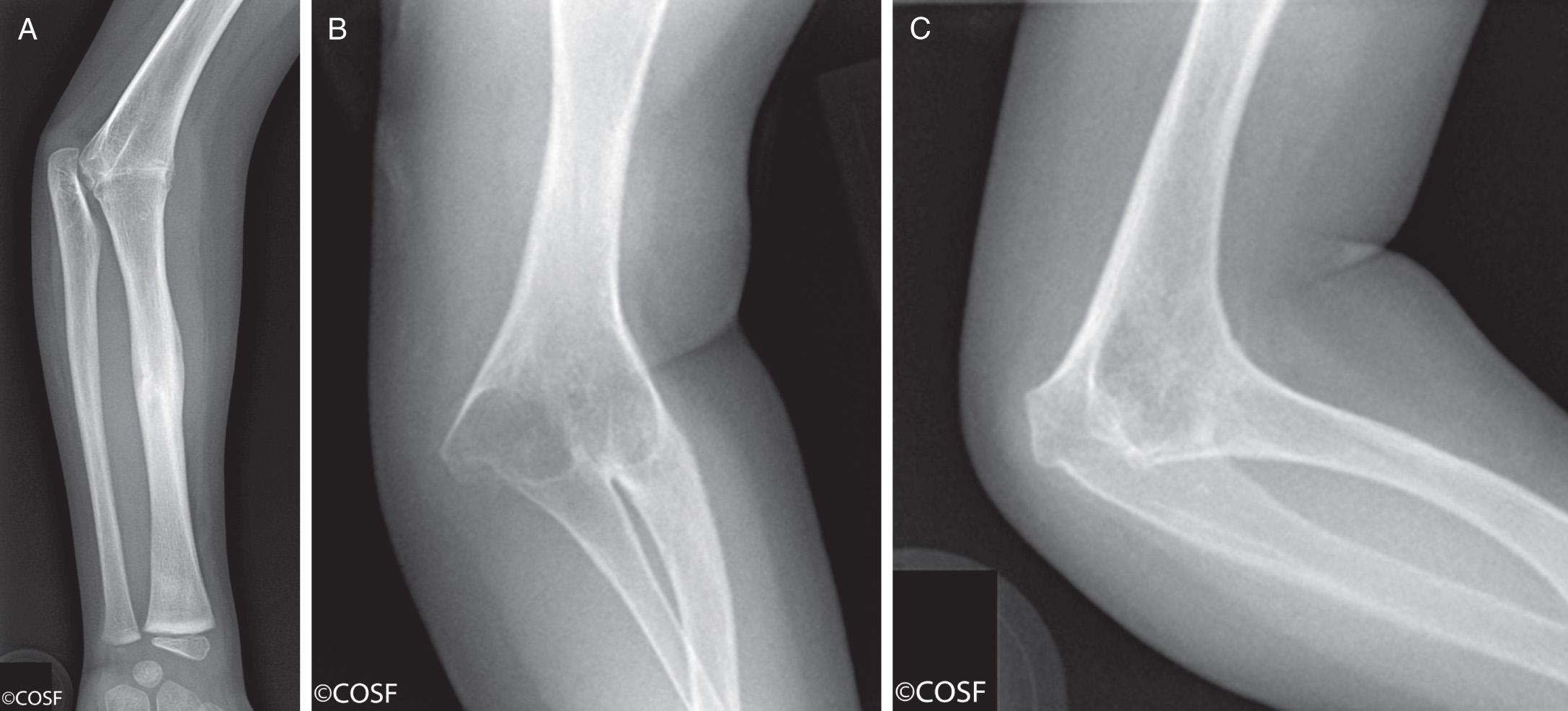 FIG 26.8, (A) Radiograph of typical radiohumeral synostosis. (B) Anteroposterior radiograph of humeroradioulnar synostosis. (C) Lateral radiograph of humeroradioulnar synostosis.