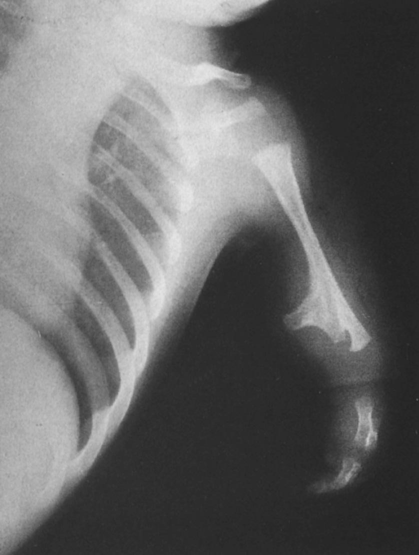 FIG 26.9, This radiograph of the upper limb of a patient with congenital phocomelia shows a fairly well-developed shoulder and arm, a very hypoplastic hand, and fusion of all elbow elements with the short ulna protruding at right angles to the radius and forearm.