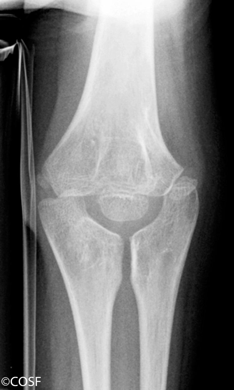 FIG 26.10, Radiograph of an elbow showing congenital ulnar dimelia with two ulnohumeral joints and no radiocapitellar joint. Motion is restricted due to the altered mechanical arrangement of the joints.