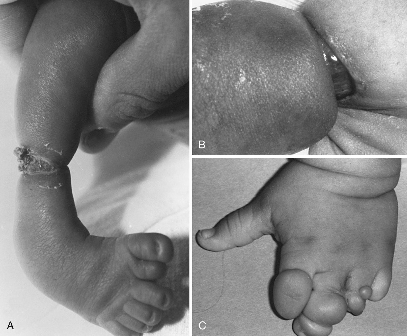 Fig. 99.2, Clinical photographs of a newborn female with multiple annular bands. A, The right lower extremity demonstrates a band with complete transection of the skin and subcutaneous tissue. The associated talipes equinovarus (clubfoot) deformity has a duplication of the great toe. B, A similar lesion is present in the right upper extremity, with a significant amount of distal edema from lymphatic and venous obstruction. C, The left hand shows multiple bands with segmented edema and partial amputations.