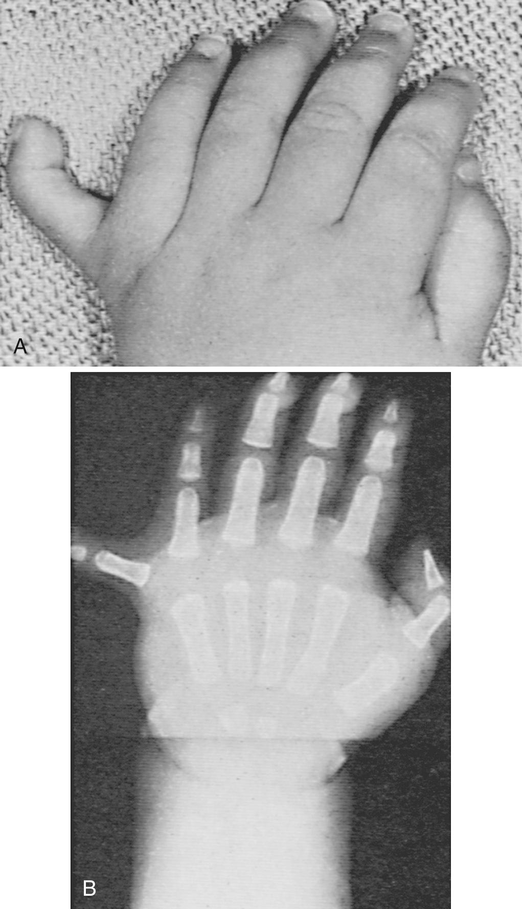 Fig. 99.4, Clinical photograph (A) and radiograph (B) show congenital polydactyly, the most common digit duplication, with complete bones, tendons, and nerves. The recommended treatment is early ablation by amputation.