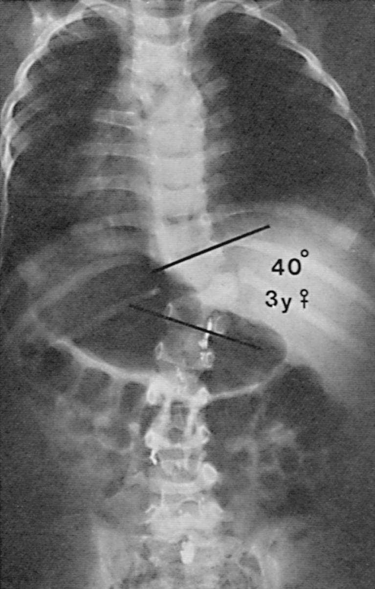 Fig. 99.5, Radiograph of congenital scoliosis in a 3-year-old girl. A hemivertebra at T12 produces a 40-degree curve over a short segment of the spine. The mixed formation and segmentation defects in the upper thoracic spine are balanced and have not produced a significant curve.