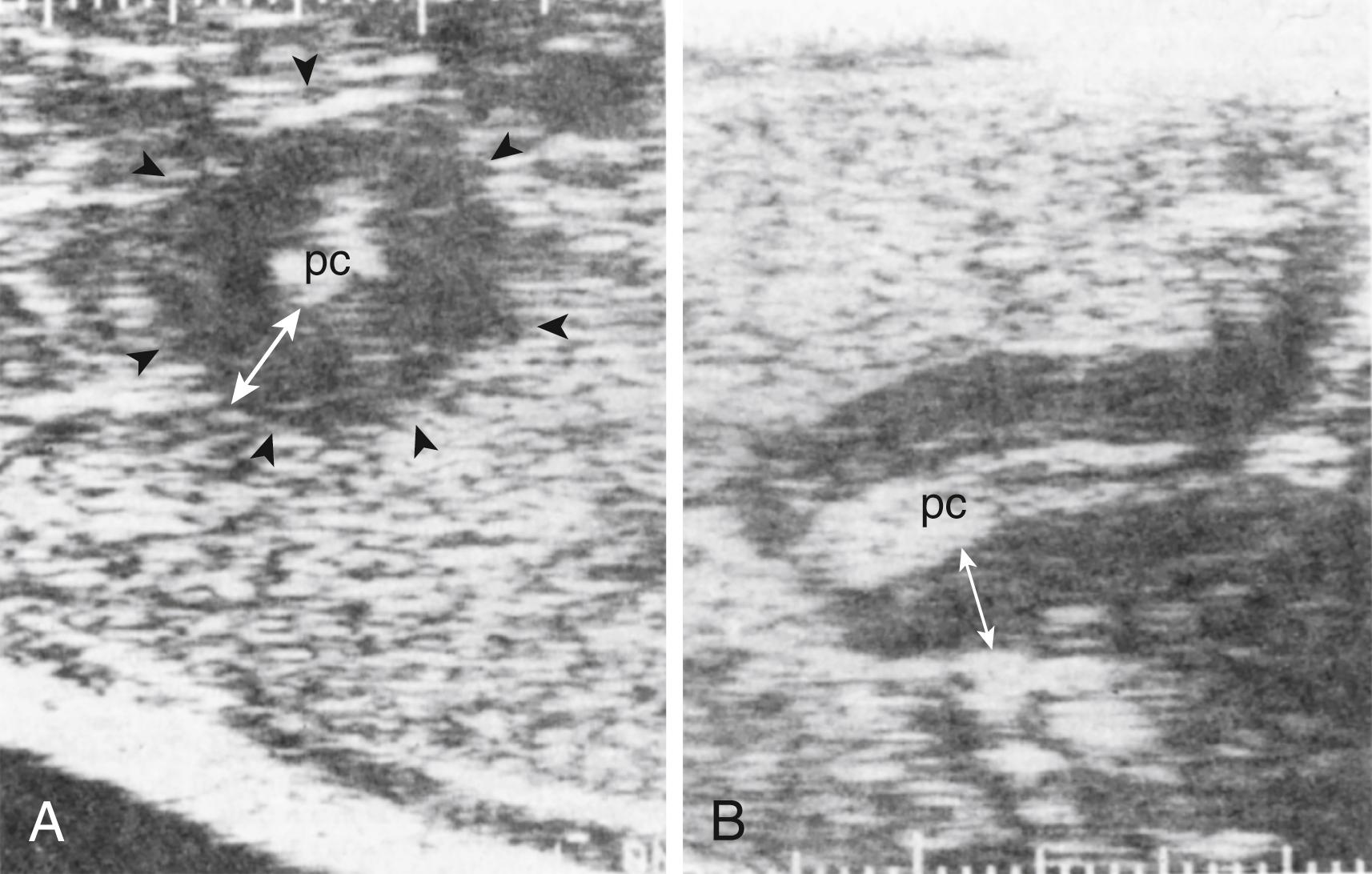 Fig. 25.1, Pyloric ultrasound demonstrating (A) transverse and (B) longitudinal views of hypertropic pylorus stenosis with increased muscle thickness and length. Black arrows outline the wall of the pylorus; the white line demonstrates the thickness of the pylorus in (A) and (B). pc , Pyloric channel.