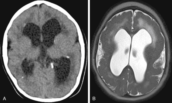 FIGURE 8-15, Bilateral pachygyria in a patient with cytomegalovirus infection. A, Axial computed tomographic (CT) image shows diffuse thickening of the cortex bilaterally with low density of the white matter. Note the periventricular calcifications. B, Axial T2-weighted imaging of the brain demonstrate diffuse thickening of the cortex and shallow sylvian fissures. The volume of the white matter is reduced. The increased T2 signal of the white matter corresponds to the decreased density in the CT representing delayed myelination.