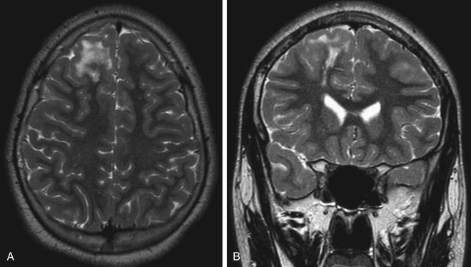 FIGURE 8-19, Cortical dysplasia, type II with balloon cells. A, Axial T2-weighted imaging (T2WI) shows a focal area of increased T2 signal in the subcortical white matter of the right frontal lobe radiating to the superolateral margin of the right frontal horn in this coronal T2WI (B) .