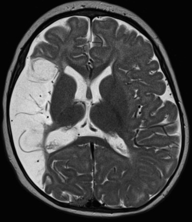 FIGURE 8-24, Intrauterine middle cerebral artery (MCA) infarct in a 7-month-old demonstrates cystic encephalomalacia in the right MCA territory. Note the lack of dysplastic gray matter lining along the borders of the encephalomalacia. In addition the remaining frontal and occipital lobes demonstrates reduced parenchymal volume, typical of intrauterine territorial infarcts.