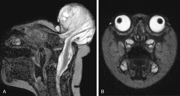 FIGURE 8-25, Anencephaly. Sagittal T2 (A) and coronal T2 (B) weighted imaging shows lack of cranial vault. Tangle of disorganized neuronal elements and glia are noted along with rudimentary brain stem.
