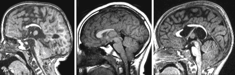 FIGURE 8-5, Examples of partial agenesis/hypogenesis of corpus callosum. A, Reduced anteroposterior diameter of the corpus callosum with lack of rostrum, genu and splenium of corpus callosum. Note the small posterior fossa, effaced fourth ventricle, flattened/elongated brain stem, inferior descent of the tonsils and tectal beaking in this patient with Chiari II malformation. B, The splenium of corpus callosum is absent. Note the inferior descent of the cerebellar tonsils below the level of foramen magnum with peg-like configuration in this patient with Chiari I malformation. C, The anterior and posterior segments of the corpus callosum are disconnected with the lack of isthmus. Note the Chiari II malformation with milder degree of findings described in A.