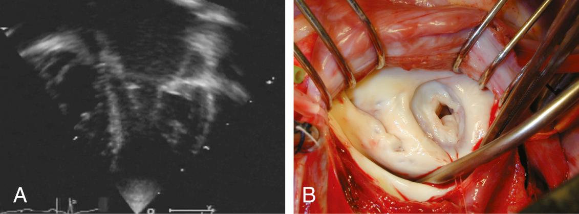 FIGURE 127-1, A, Two-dimensional echocardiogram of supravalvar mitral ring, apical view. The membrane attached at mid height of the anterior leaflet is characteristic. The posterior part of the membrane is only suggested by the hyperechogenicity of the posterior annulus. B, Intraoperative photograph of a supravalvar mitral ring. Note the implantation of the supravalvar mitral ring high close to the annulus on the posterior leaflet side (inferior side of the picture) and at the mid level of the anterior leaflet (left side of the picture).