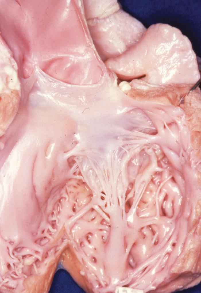 FIGURE 127-2, Macroscopic view of a parachute mitral valve. A large predominant papillary muscle distributes anomalous chords to both commissures. A small diminutive papillary muscle is seen to the right of the valve.