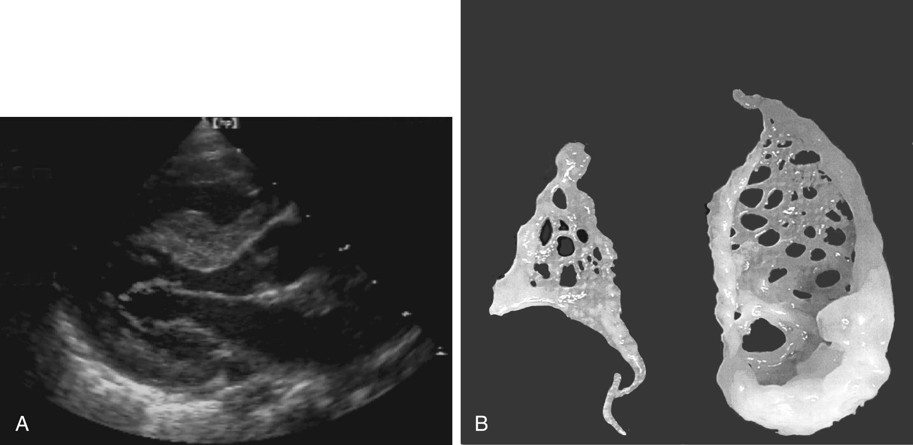 FIGURE 127-4, Accessory mitral valve tissue. A, Long-axis view. The accessory mitral valve tissue is attached to the anterior and posterior leaflets of the mitral valve and blown like a windsock. B, Macroscopic view of the same tissue after surgical resection is characteristic of accessory mitral valve tissue attached to the suspension apparatus.