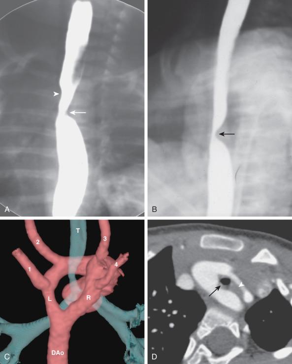 Figure 76.2, Bilaterally patent double aortic arches in a 7-year-old boy.