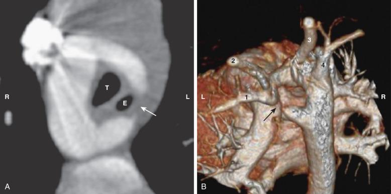 Figure 76.3, Double aortic arch with an atretic left arch in a 2-year-old girl.