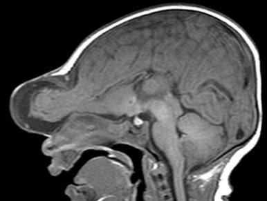 Figure 31.1, Frontal encephalocele in a neonate.