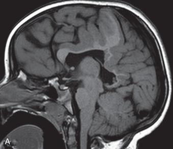 Figure 31.12, Syntelencephaly (middle frontal variant of holoprosencephaly).