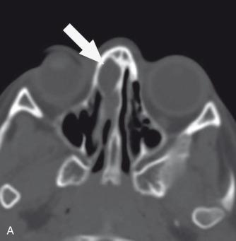 e-Figure 31.2, Incident nasofrontal encephalocele found on CT done for trauma.