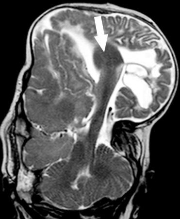 e-Figure 31.4, Large parietal encephalocele.