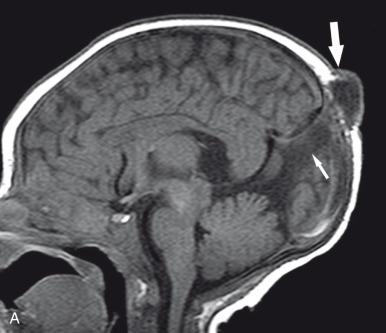 e-Figure 31.5, Atretic parietal meningocele.