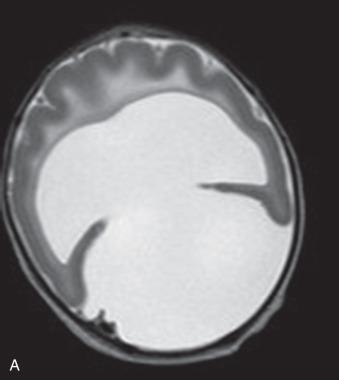 Figure 31.10, Holoprosencephaly (HPE).