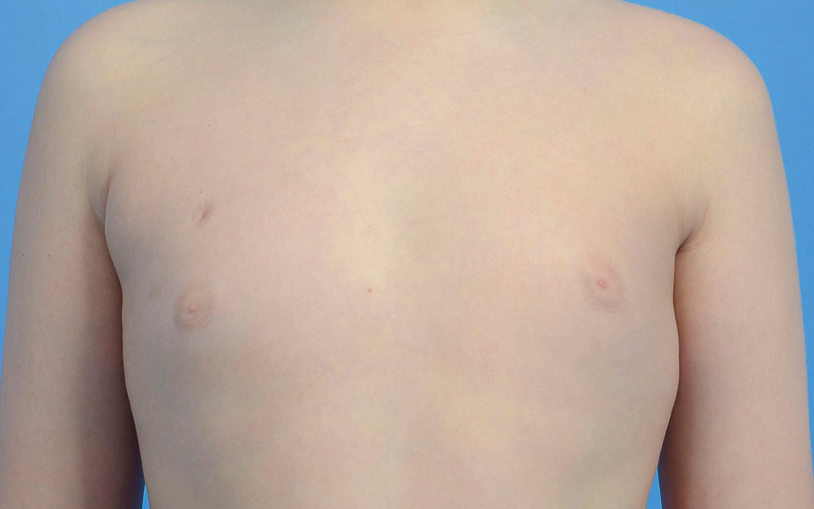 Fig. 37.1, A 10-year-old male with polythelia seen along the right mammary ridge superior to the true nipple–areola complex.