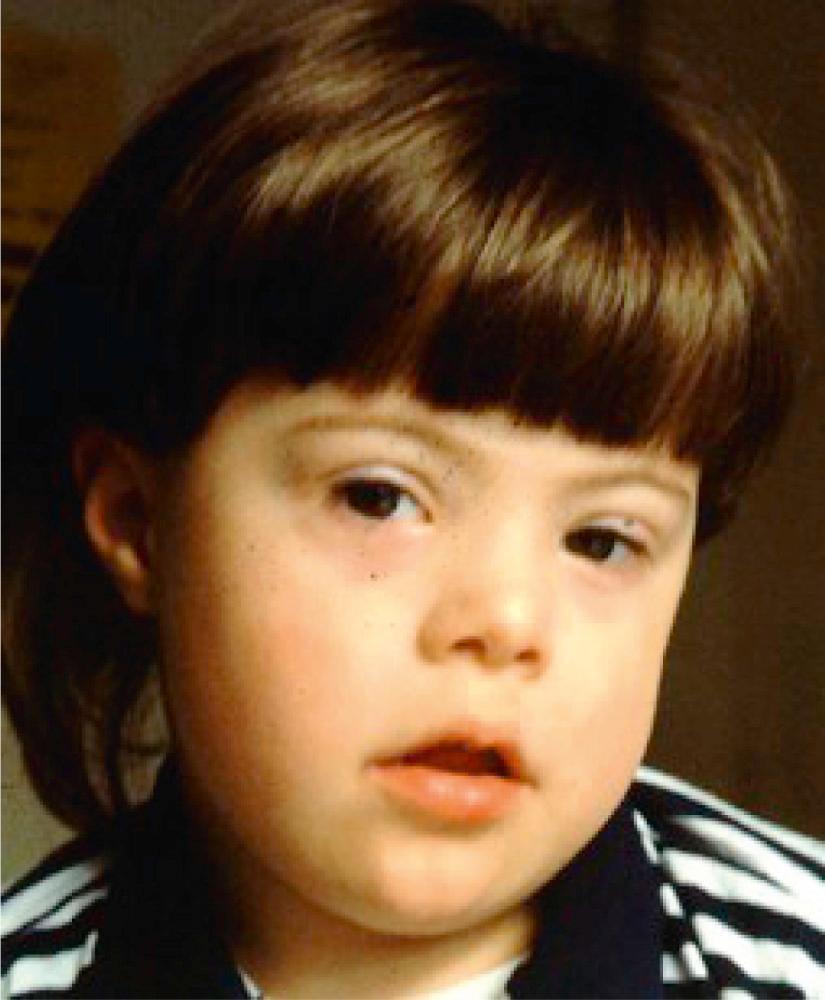 Fig. 77.1, Facial appearance of Down syndrome.