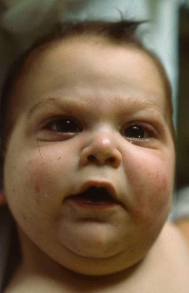 Fig. 77.3, Facial appearance of deletion 8p23 syndrome.