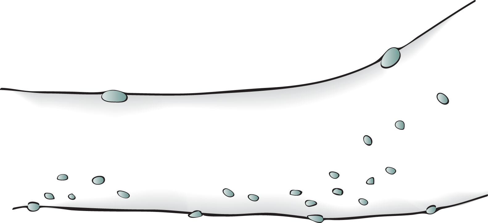 Fig. 13.11, Neurofibromas are most often subtle, multiple, subcutaneous, soft, and typically less than 0.5 cm in size.