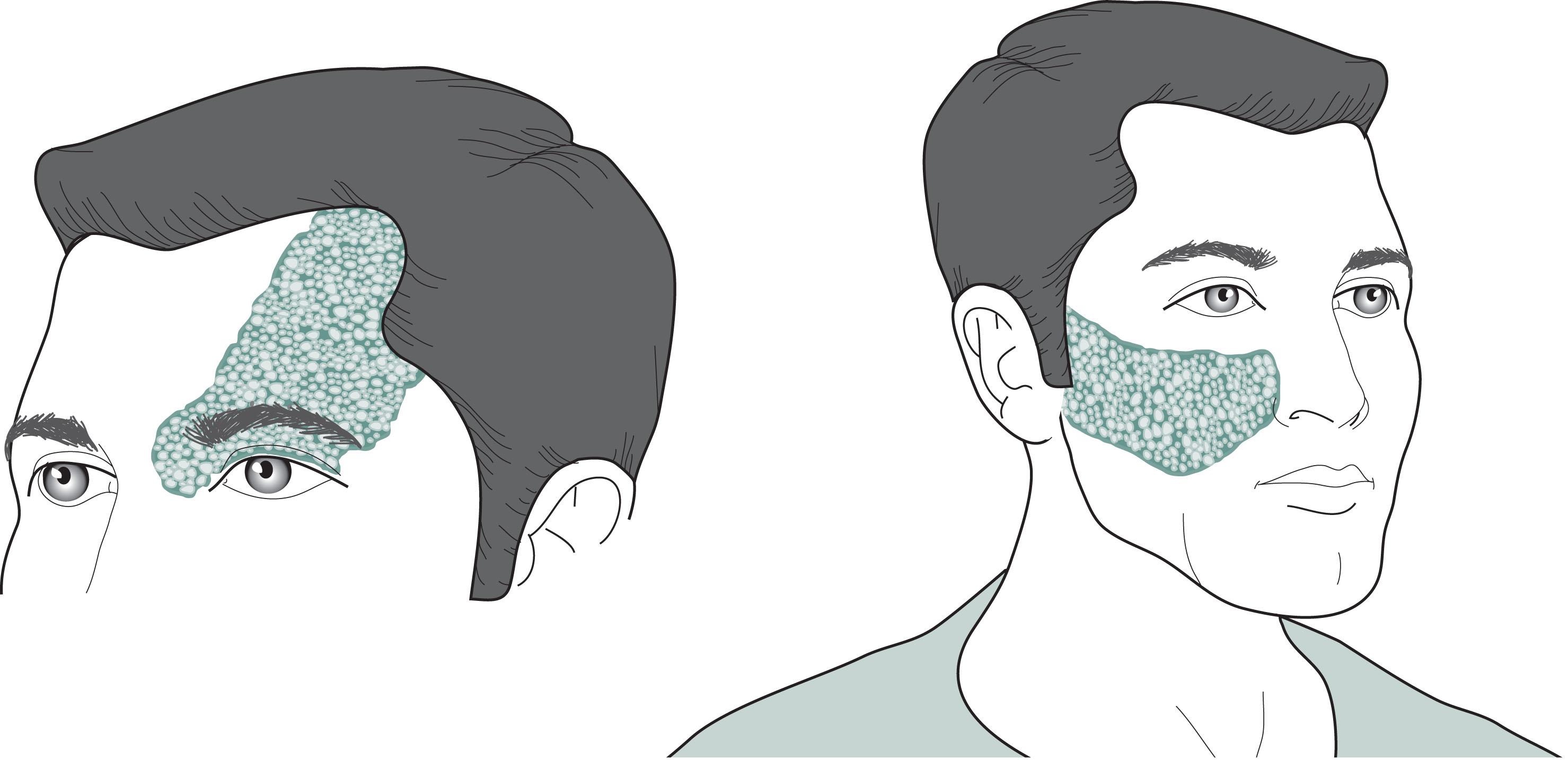 Fig. 13.13, The cutaneous angioma (port wine stain) of Sturge-Weber syndrome encompasses one or more divisions of the trigeminal nerve (see Fig. 4.12 ). The commonest sites are the anterior scalp, forehead, and upper eyelid, i.e., the first division.