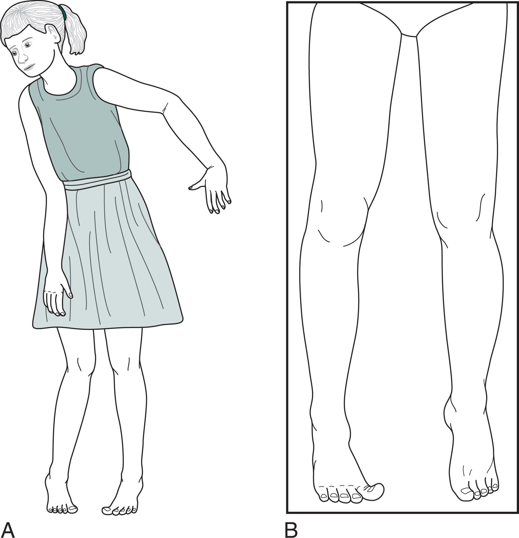 Fig. 13.3, (A) Spastic diplegia in this 10-year-old girl with low-normal intelligence causes straightening, inturning, and adduction of her legs; a tiptoe stance; and scissor-like gait. Her uncoordinated, awkward arm movements (posturing) also reflect her cerebral palsy. (B) An 18-year-old college engineering student with spastic diplegia also shows adduction of his legs and toe-walking. He also has a spontaneous right-sided Babinski sign.