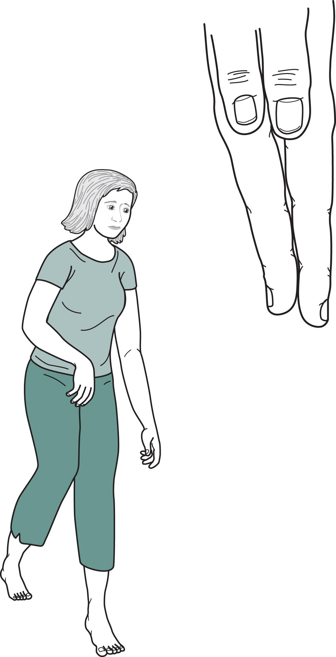 Fig. 13.4, Hemiparetic since birth, this 28-year-old woman with normal intelligence holds her spastic and weak arm, wrist, and fingers in a flexed posture. Her right hand has shortened fingers and a less broad thumbnail bed. Because her right leg is spastic, she circumducts that leg when walking. Her right Achilles tendon is short, forcing her to toe-walk on her right. Overall, her posture and gait are similar to adults after a left middle cerebral artery infarction (see Figs. 2.3 – 2.5 ).