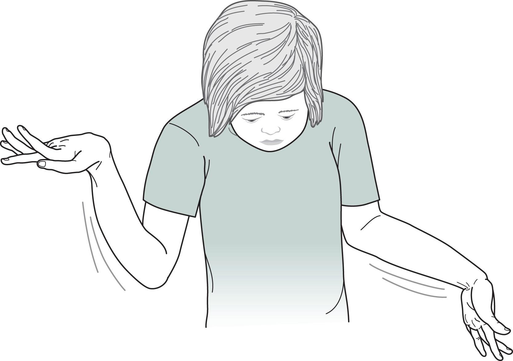 Fig. 13.5, This 13-year-old girl with congenital choreoathetosis has extrapyramidal or cerebral palsy. Her wrists, hands, and fingers show slow, sinuous movements (athetosis), and her trunk and limbs superimpose large-amplitude jerky movements (chorea). The athetosis forces her hands into flexion at the wrist and her fingers into extension.