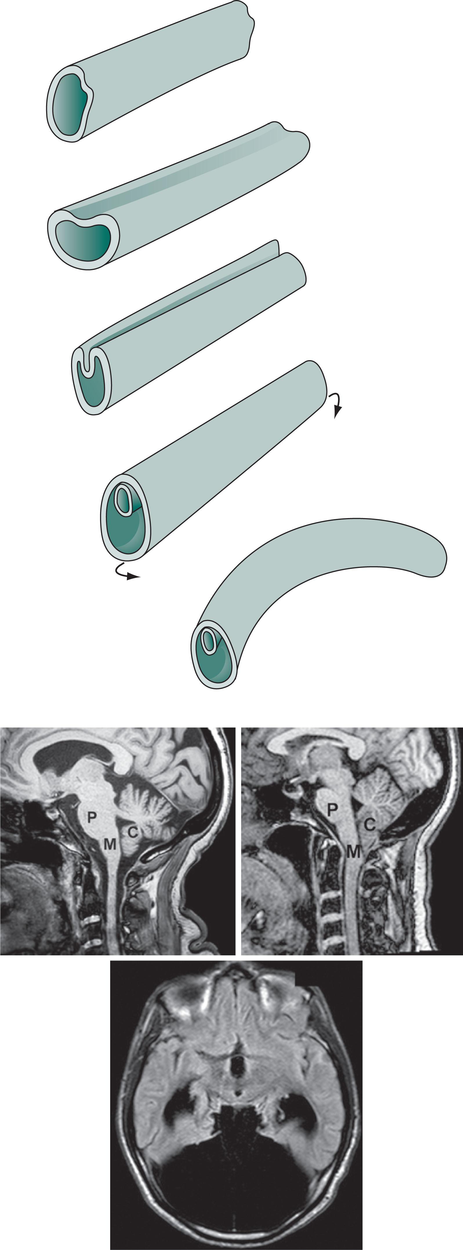 Fig. 13.6, Top . During early gestation, the embryo’s ectoderm invaginates to shape a midline neural tube that eventually closes at both ends. The embryo assumes a curved shape with the tube on the outer surface. Middle left . The magnetic resonance imaging (MRI) shows the normal relationship of posterior fossa structures: the pons (P) , medulla (M) , cerebellum (C) , and the fourth ventricle (unmarked black, triangular area between the pons and cerebellum). Note the medulla and lower portion of the cerebellum remain above the foramen magnum. Middle right . This MRI shows an Arnold-Chiari malformation. The lower portion of the cerebellum (C) , which includes the tonsils, and the medulla (M) , crowded together, protrude down through the foramen magnum.