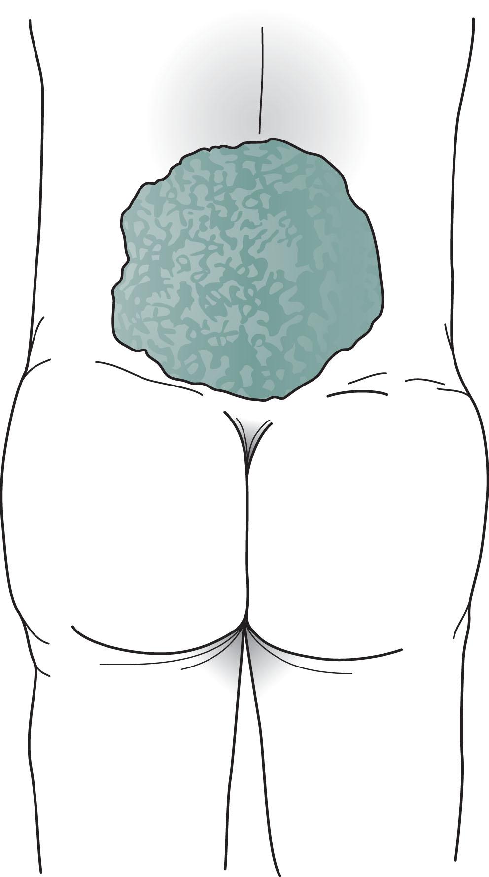 Fig. 13.7, The meningomyelocele of this newborn has a typical broad-based, loose, translucent sac of thin, friable skin arising from the lumbar area. It contains rudiments of the lumbosacral spinal cord and nerves of the cauda equina. Its surface weeps a mixture of serum and cerebrospinal fluid (CSF). The infant’s legs, lacking innervation, remain weak, flaccid, and areflexic. The bladder, also lacking innervation, distends and leads to hydronephrosis.