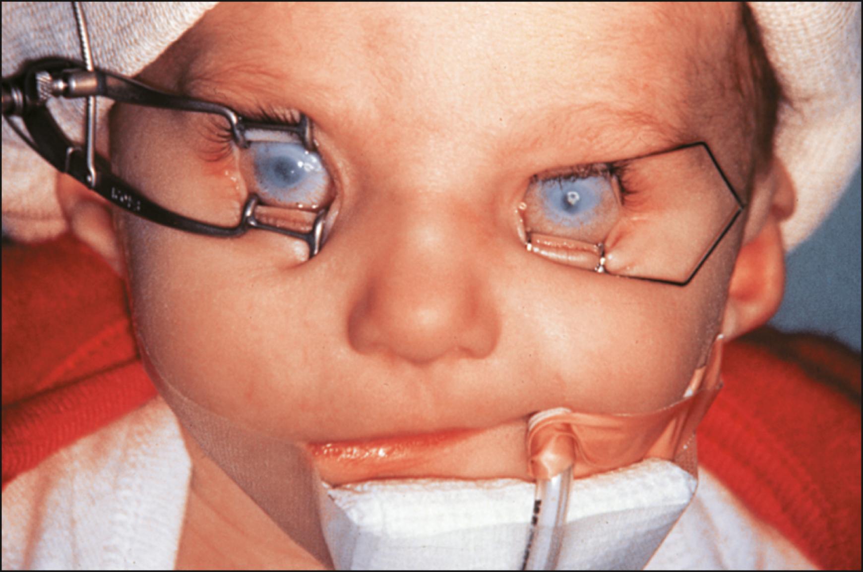 Fig. 18.1, An infant with sclerocornea being examined under general anesthesia.
