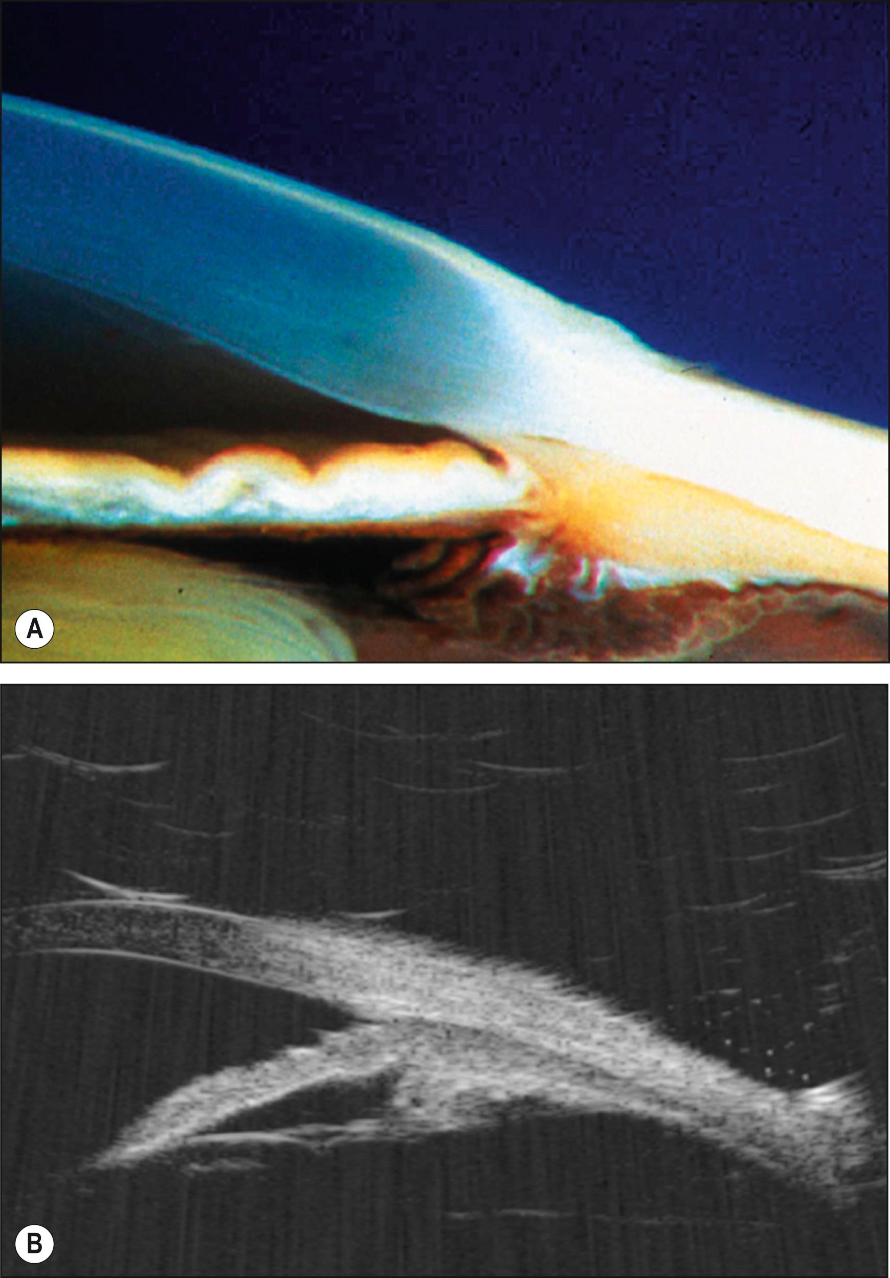Fig. 18.3, Anatomic structures of the anterior segment, specifically the iridocorneal angle, as visualized by ( A ) gross, pathologic cross-section and ( B ) ultrasound biomicroscopy (UBM).