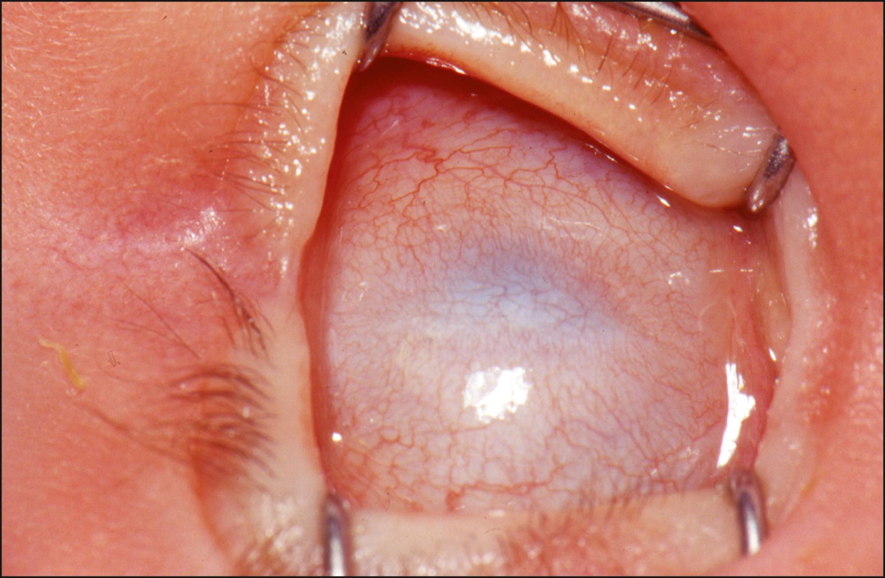 Fig. 18.5, Total sclerocornea: complete opacification of the entire cornea.