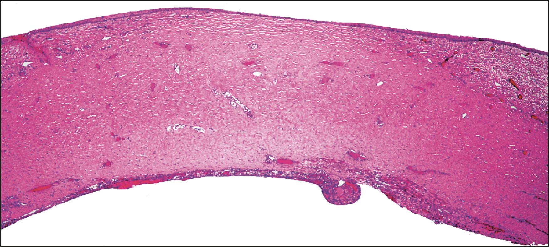 Fig. 18.6, Histopathology of sclerocornea (see also Box 18.4 ).