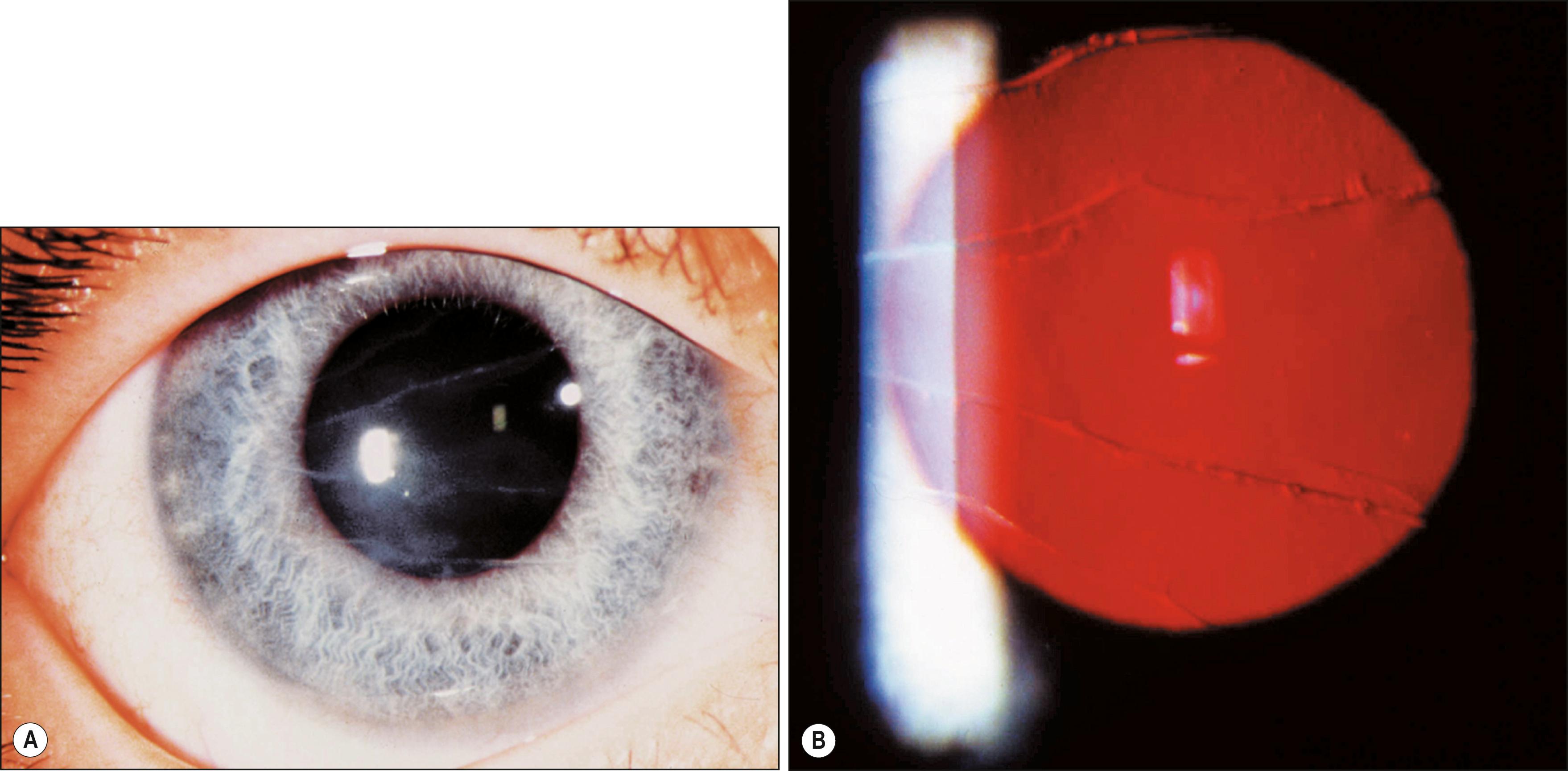 Fig. 18.8, Horizontal breaks in Descemet membrane (Haab striae) in an infant with congenital glaucoma: striae are seen in ( A ) direct illumination and ( B ) retroillumination.