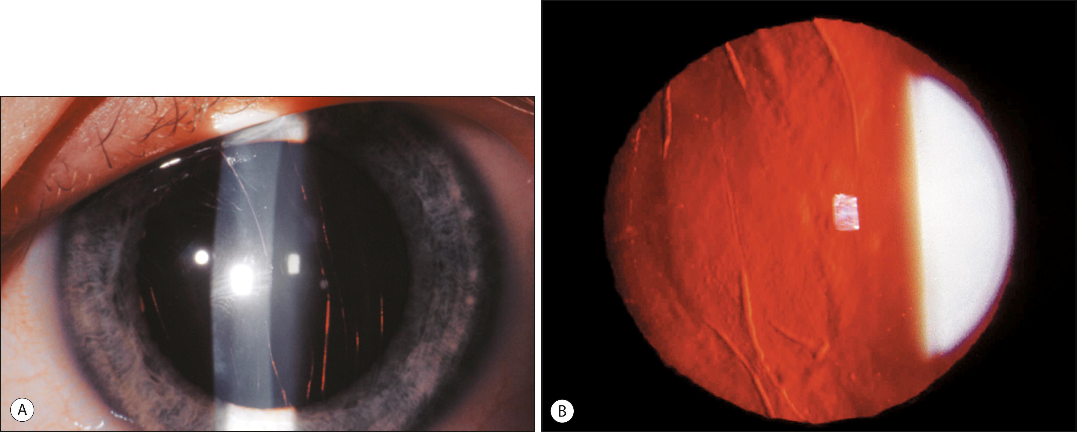 Fig. 18.9, Vertical and oblique distribution of Descemet tears in an infant due to birth trauma seen in ( A ) direct illumination and ( B ) retroillumination.