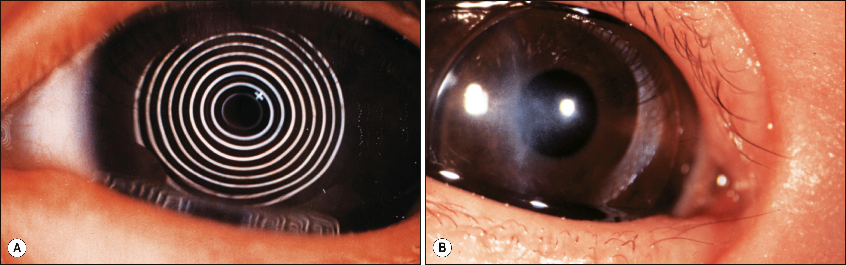 Fig. 18.10, Birth trauma: ( A ) keratometry and ( B ) Rigid gas-permeable contact lenses in a 2-month-old child with high with-the-rule astigmatism due to forceps injury.