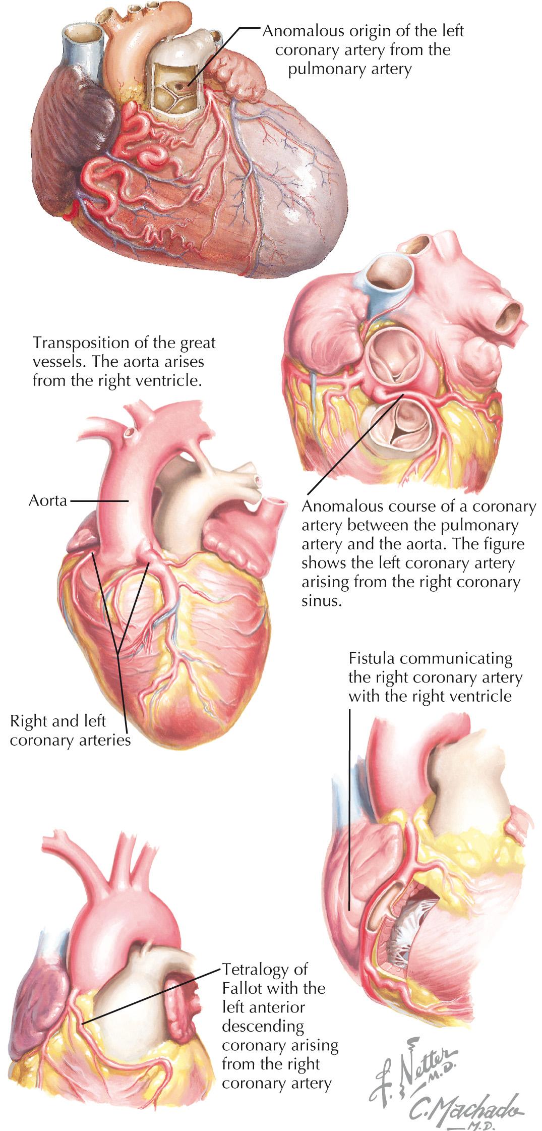 FIG 25.2, Congenital Coronary Artery Anomalies.