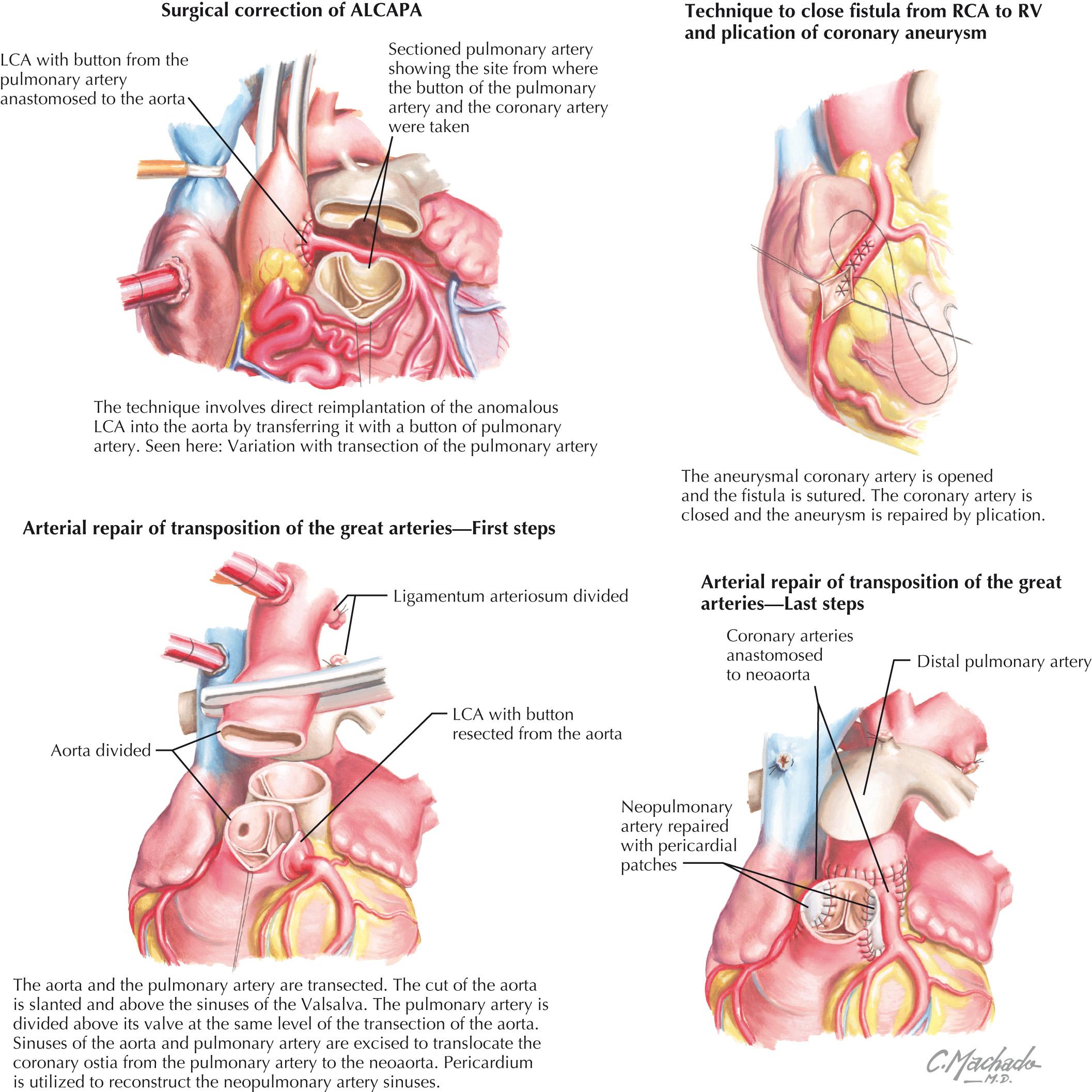 FIG 25.3, Surgical Procedures for Correction of Congenital Coronary Artery Anomalies.