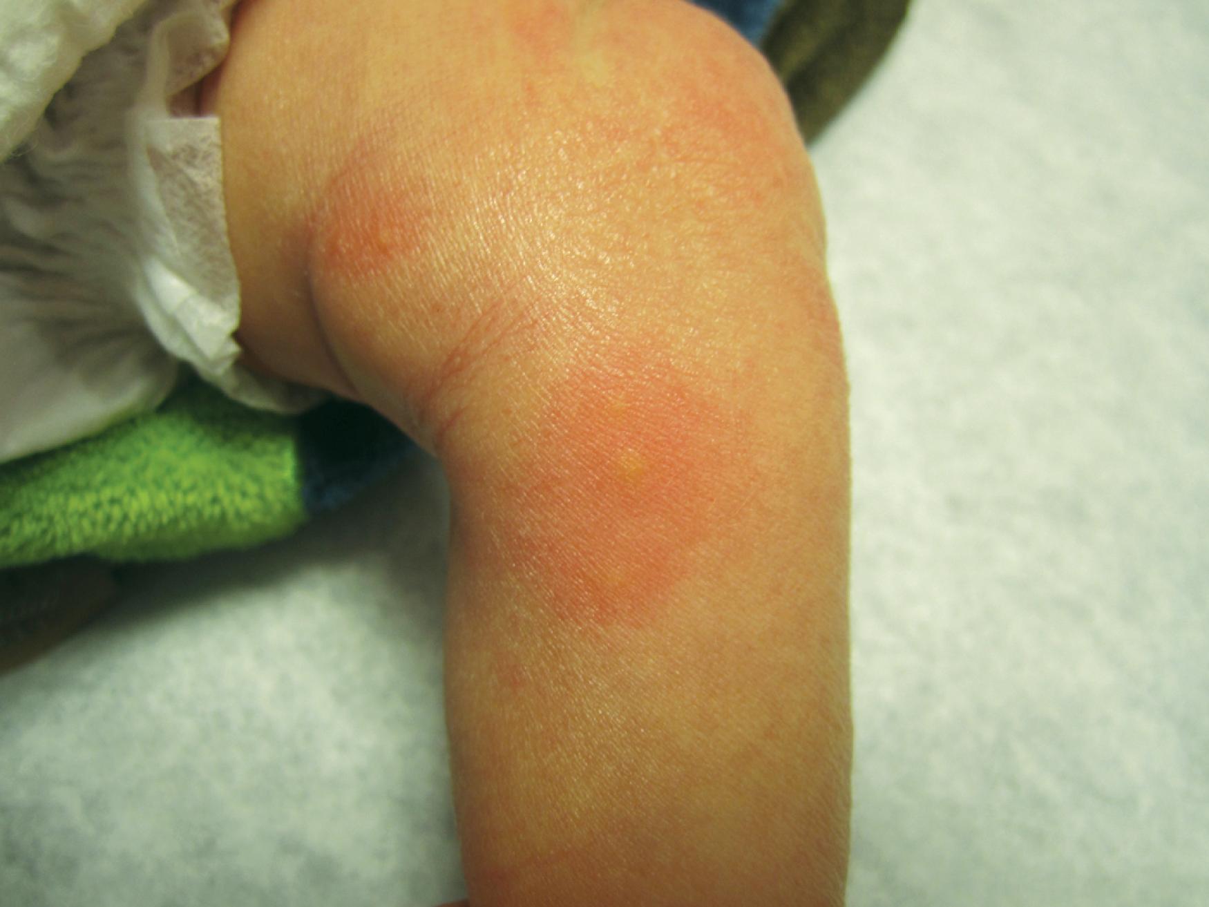 Fig. 60.1, Papules surrounded by erythema are characteristic of erythema toxicum. Typically it is located on the trunk but can be on the extremities as well.