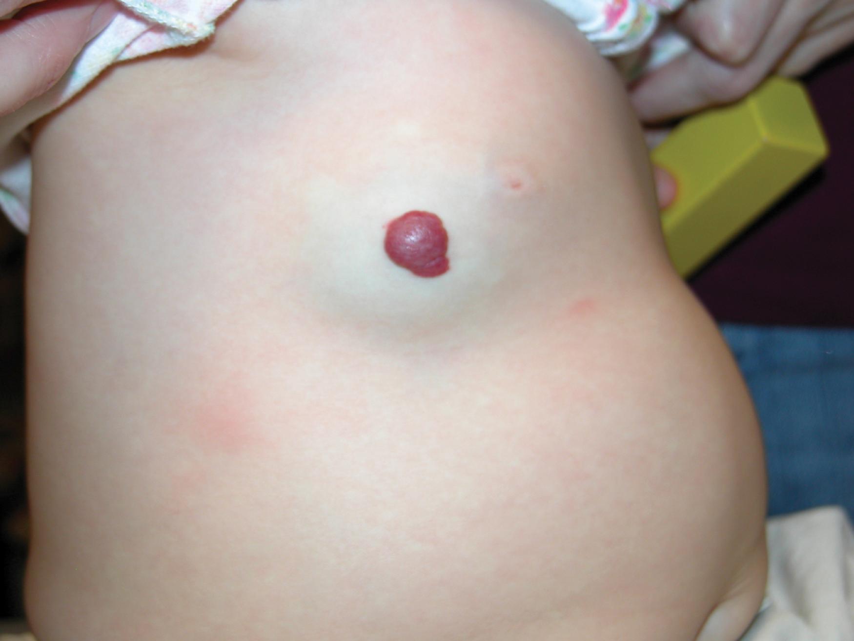 Fig. 60.11, A mixed hemangioma with prominent deep component on the trunk.