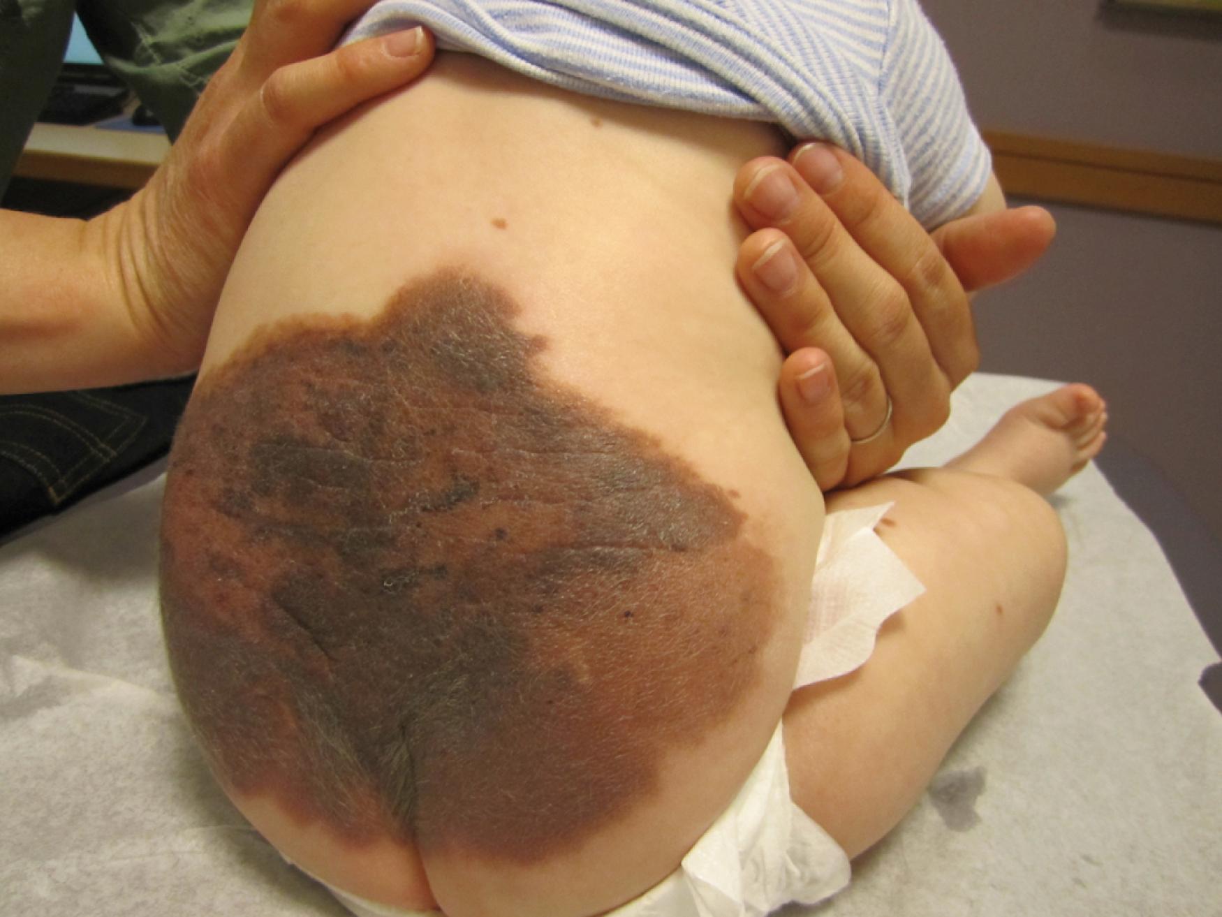 Fig. 60.13, Giant congenital melanocytic nevus of the lower back. Imaging should be considered to evaluate for tethered cord or spinal dysraphism, as well as melanosis of the spine or brain.