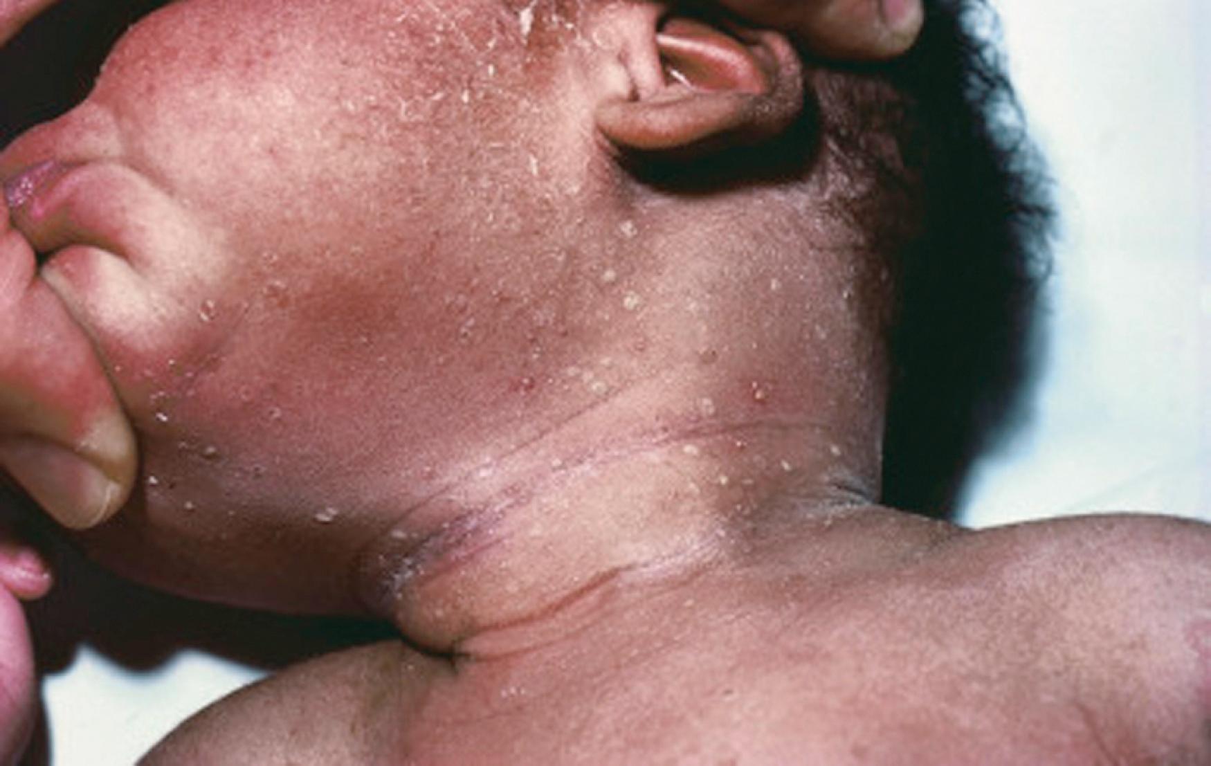 Fig. 60.2, Transient neonatal pustular melanosis. Papules and papulopustules rupture to leave a collarette of fine scales and eventual hyperpigmentation.