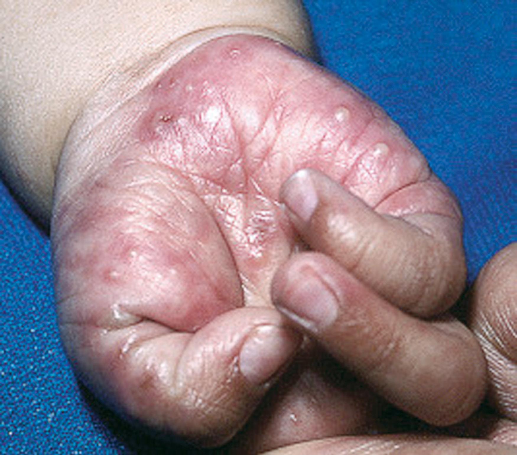 Fig. 60.3, Acropustulosis of infancy. Multiple tense erythematous papules and pustules on the palm of this 4-month-old girl.