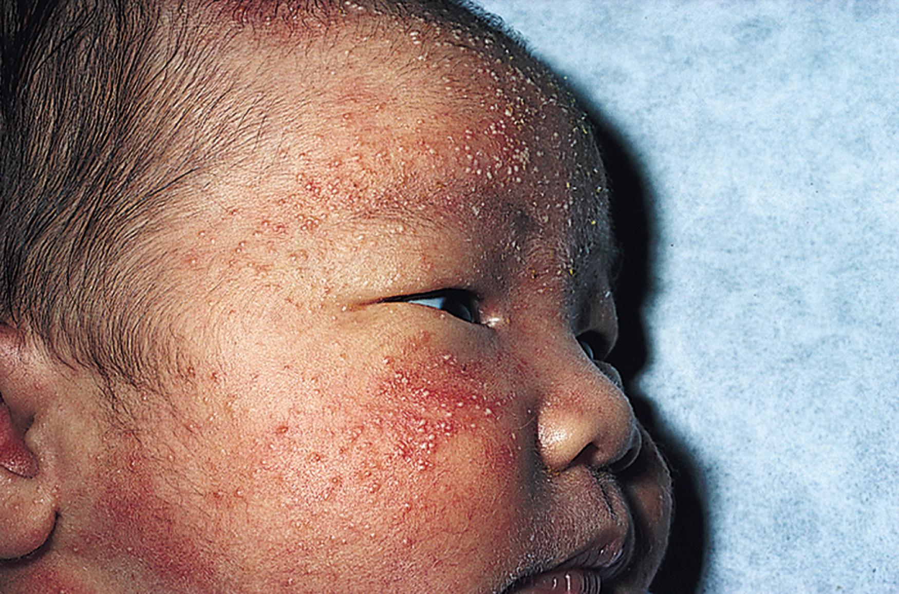 Fig. 60.4, Neonatal acne (cephalic pustulosis) is usually found on the cheeks and scalp in the first 2–4 weeks of life; small red papules and pustules without comedones are evident.