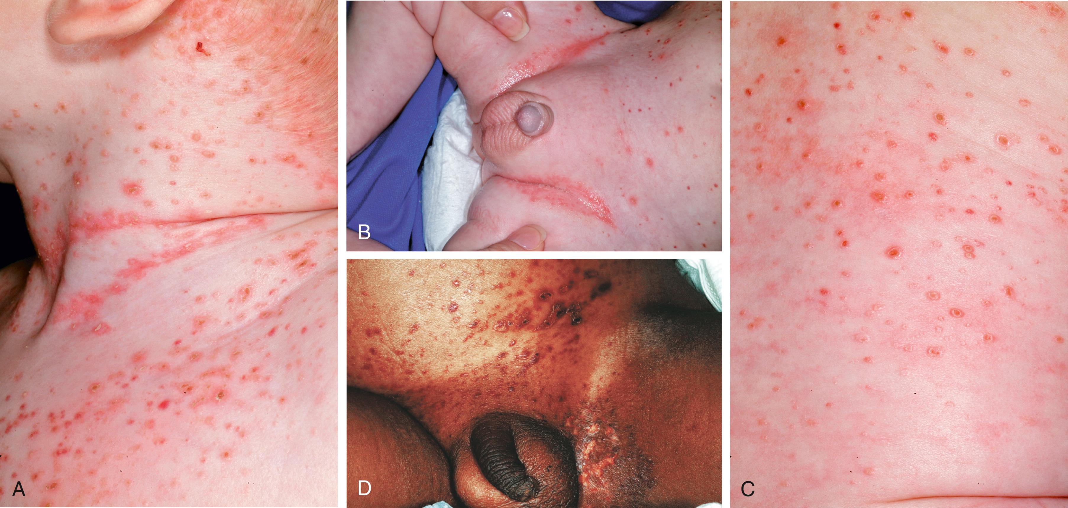 Fig. 60.5, Langerhans cell histiocytosis (LCH). A–C, Erythematous and eroded papules in the neck fold and inguinal creases and over the trunk. Note the associated crusting, purpura, and umbilicated nature of some of the papules. D, Eroded, erythematous, and hemorrhagic papules in the groin of this infant with disseminated LCH. Note the associated jaundiced appearance, a result of massive liver involvement.